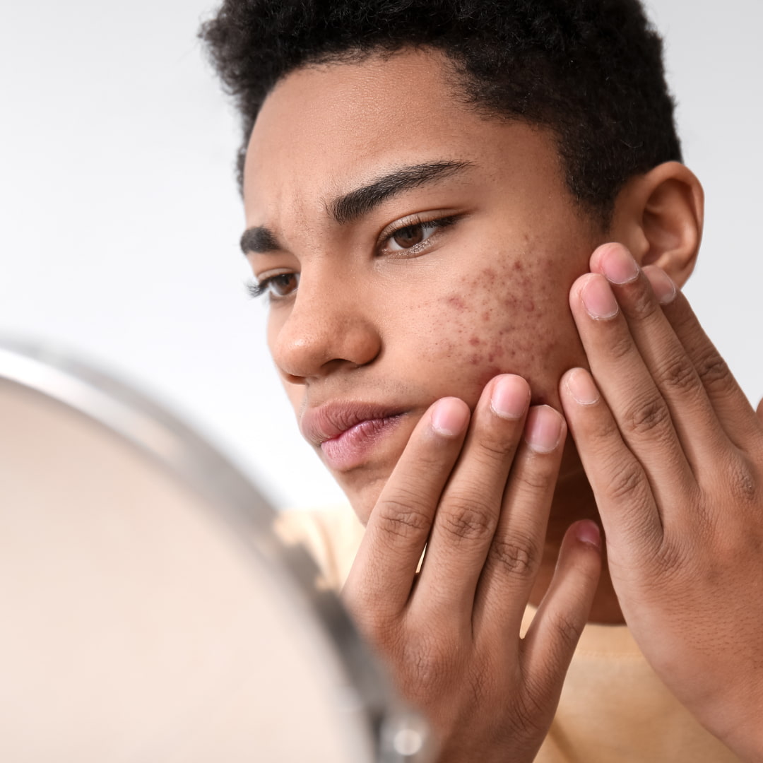 Teenage Facial Ayur Veda Organic wellness clinics Malta